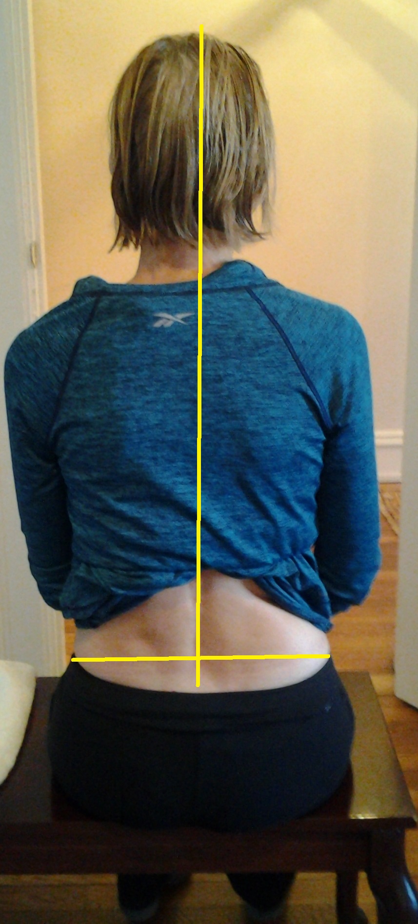 The lateral pelvic tilt : the degree of lateral pelvic tilt is measured